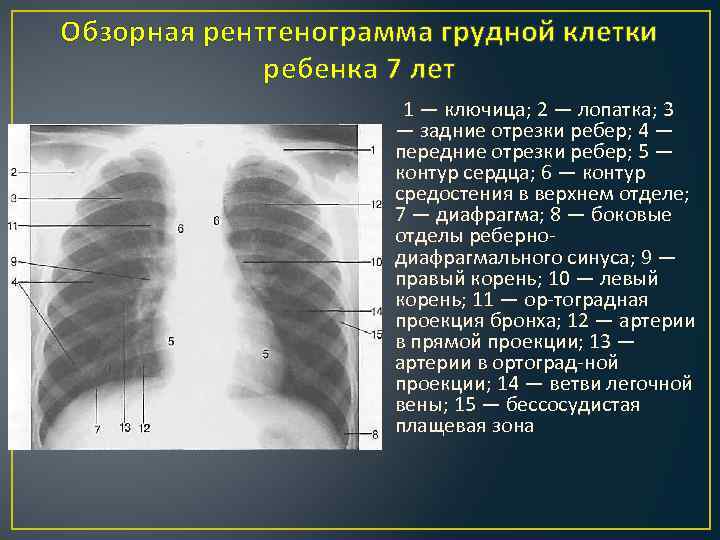Обзорная рентгенограмма грудной клетки ребенка 7 лет 1 — ключица; 2 — лопатка; 3