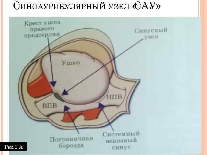 СИНОАУРИКУЛЯРНЫЙ УЗЕЛ « САУ» Рис. 1 А 