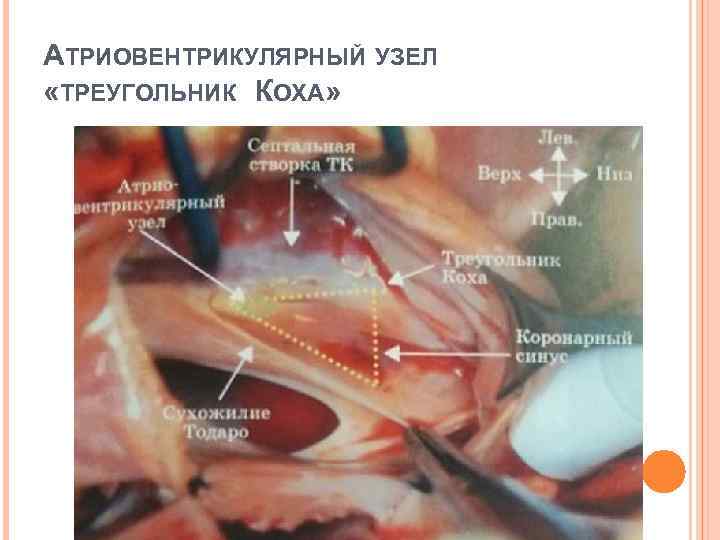 АТРИОВЕНТРИКУЛЯРНЫЙ УЗЕЛ «ТРЕУГОЛЬНИК КОХА» 