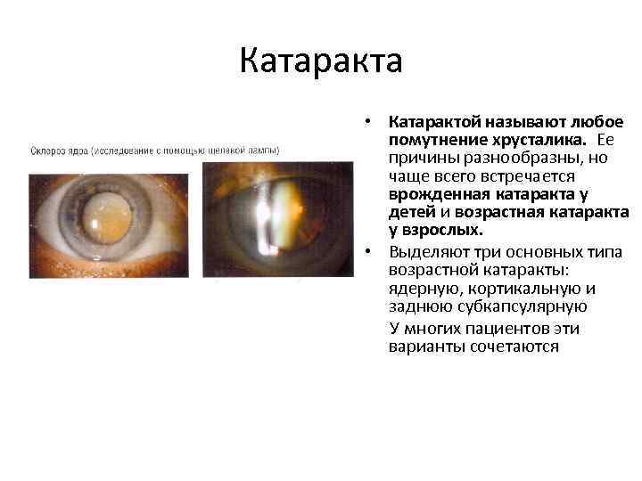 Схема фокусировки лучей при ядерной катаракте