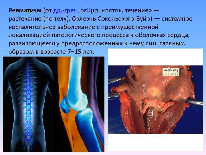 Ревмати зм (от др. -греч. ῥεῦμα, «поток, течение» — растекание (по телу), болезнь Сокольского-Буйо)