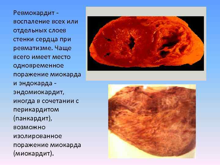 Ревмокардит - воспаление всех или отдельных слоев стенки сердца при ревматизме. Чаще всего имеет
