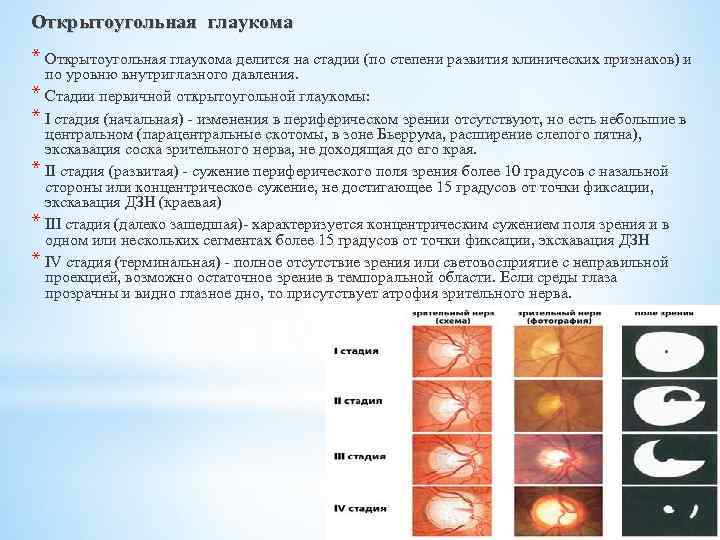 Классификация глаукомы. Первичная открытоугольная глаукома 2-3 степени. Первичная открытоугольная глаукома 3а. Стадии открытоугольной глаукомы. Начальная стадия первичной глаукомы.