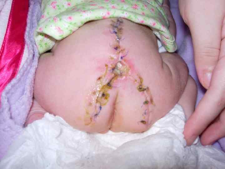 Повязки с применением резинового клея При равномерном смазывании наложенной повязки резиновым клеем (раствор резины