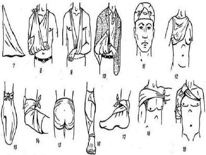 Перевязка определение. Повязка косынка десмургия. Десмургия общая хирургия. Десмургия виды повязок в картинках. Наложение Косыночная повязка конечность.
