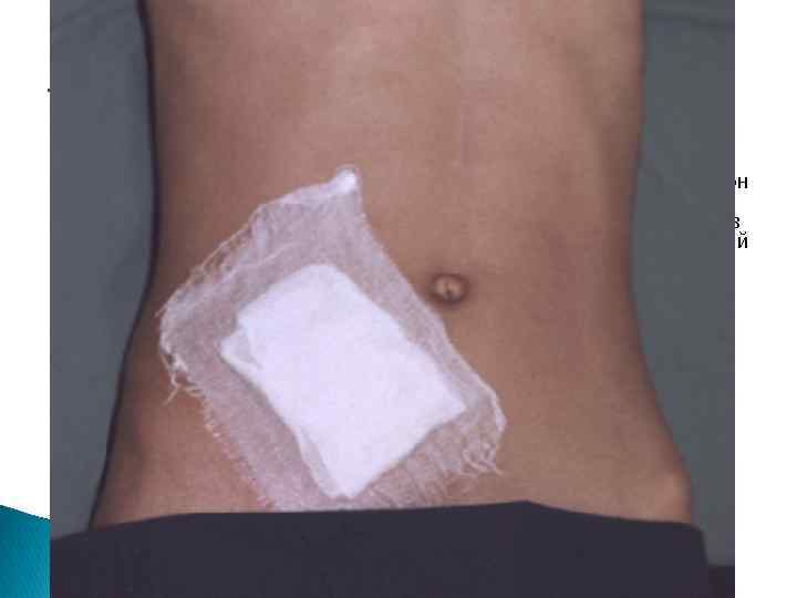 Клеоловая повязка применяется в тех же случаях, что и пластырная. На пораженный участок накладывают