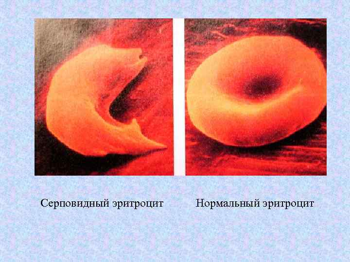 Серповидный эритроцит Нормальный эритроцит 