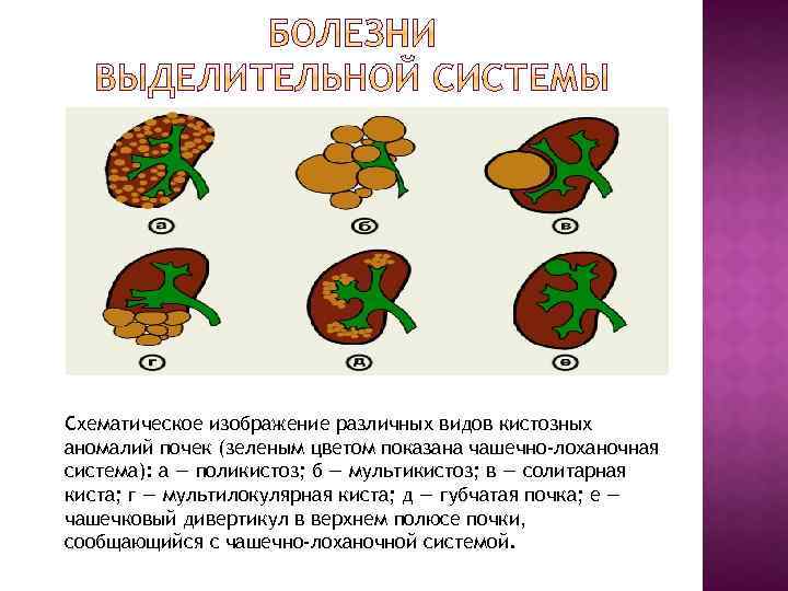 Схематическое изображение различных видов кистозных аномалий почек (зеленым цветом показана чашечно-лоханочная система): а —