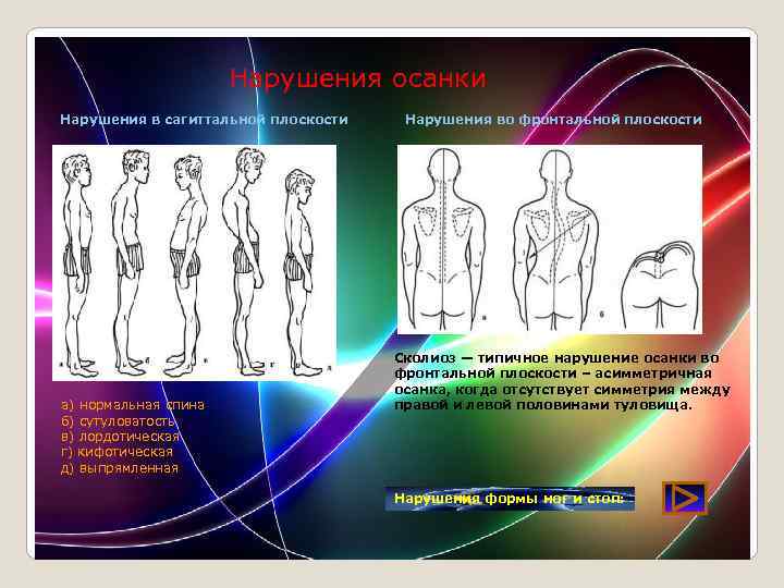 Нарушения осанки Нарушения в сагиттальной плоскости а) нормальная спина б) сутуловатость в) лордотическая г)
