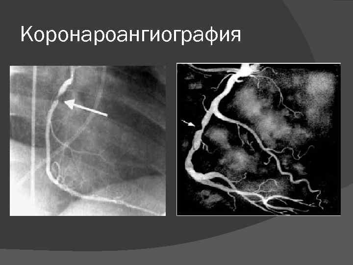 Коронароангиография 