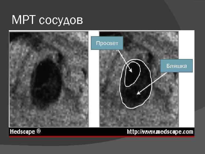 МРТ сосудов Просвет Бляшка 