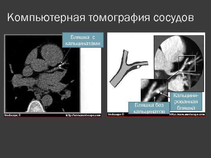 Компьютерная томография сосудов Бляшка с кальцинатами Бляшка без кальцинатов Кальцинированная бляшка 