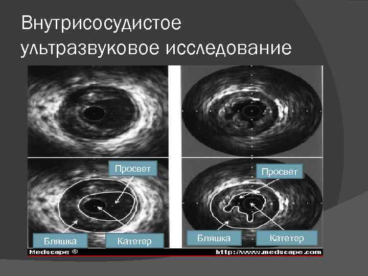 Внутрисосудистое ультразвуковое исследование Просвет Бляшка Катетер 