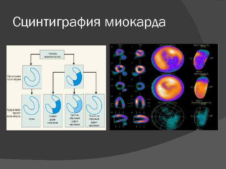 Сцинтиграфия миокарда 