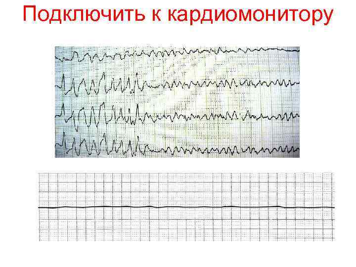 Подключить к кардиомонитору 