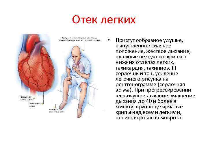 Отек легких • Приступообразное удушье, вынужденное сидячее положение, жесткое дыхание, влажные незвучные хрипы в