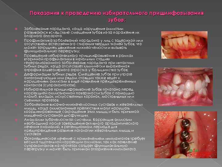 Показания к проведению избирательного пришлифовывания зубов: Заболевания пародонта, когда нарушения окклюзии развиваются вследствие смещения