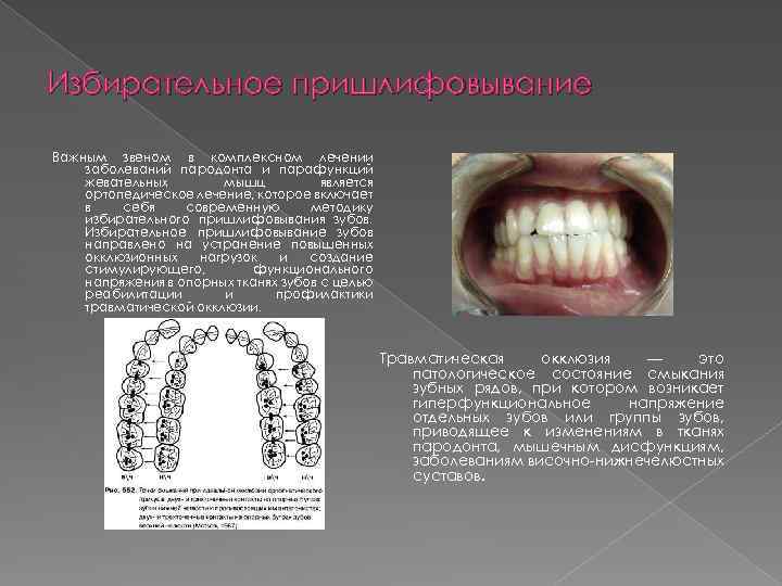 Избирательное пришлифовывание Важным звеном в комплексном лечении заболеваний пародонта и парафункций жевательных мышц является