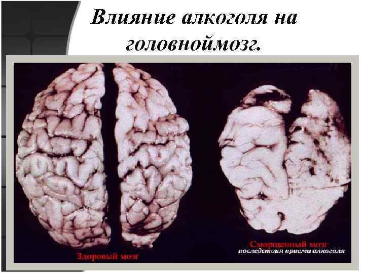 Влияние алкоголя на головноймозг. 