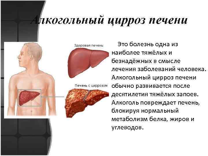 Алкогольный цирроз печени Это болезнь одна из наиболее тяжёлых и безнадёжных в смысле лечения