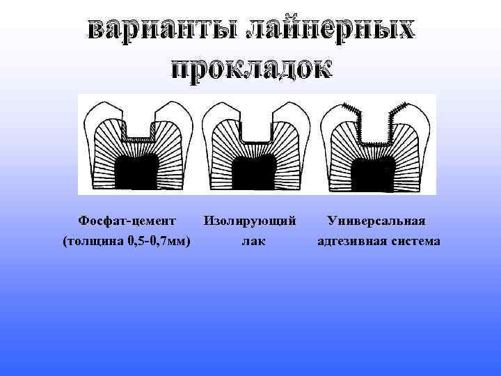 варианты лайнерных прокладок Фосфат-цемент Изолирующий (толщина 0, 5 -0, 7 мм) лак Универсальная адгезивная