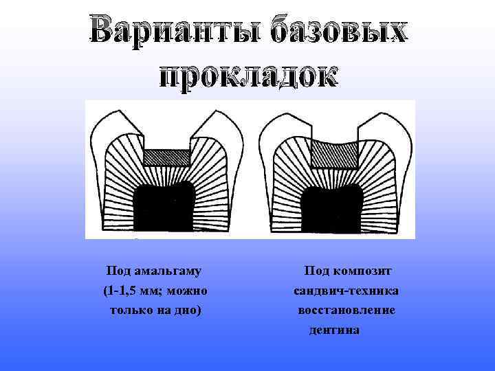 Материалы для лечебных и изолирующих прокладок презентация