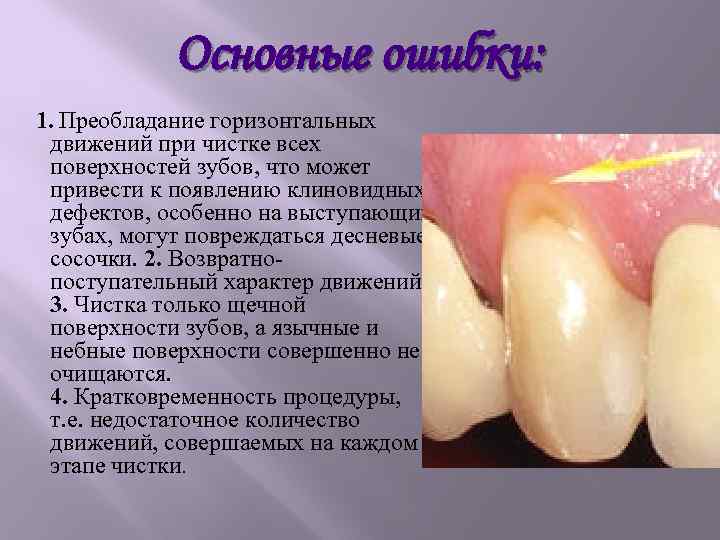 Основные ошибки: 1. Преобладание горизонтальных движений при чистке всех поверхностей зубов, что может привести