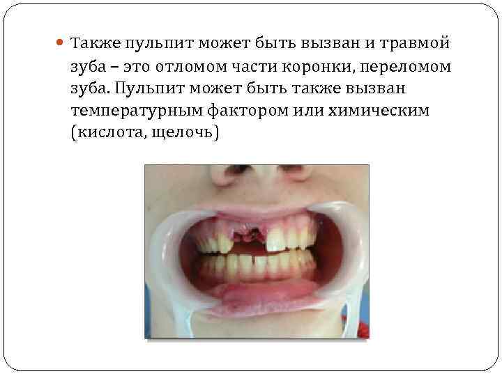  Tакже пульпит может быть вызван и травмой зуба – это отломом части коронки,