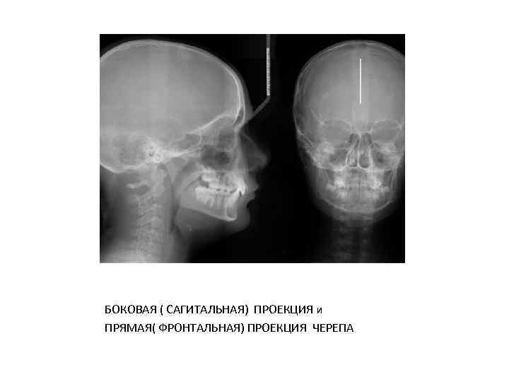 БОКОВАЯ ( САГИТАЛЬНАЯ) ПРОЕКЦИЯ и ПРЯМАЯ( ФРОНТАЛЬНАЯ) ПРОЕКЦИЯ ЧЕРЕПА 