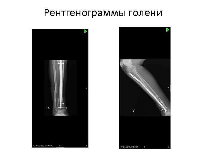 Информативность рентгеновского изображения