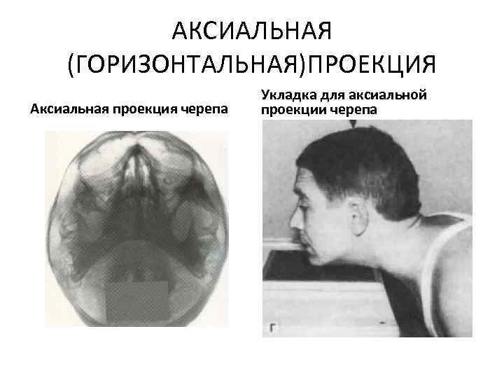 АКСИАЛЬНАЯ (ГОРИЗОНТАЛЬНАЯ)ПРОЕКЦИЯ Аксиальная проекция черепа Укладка для аксиальной проекции черепа 