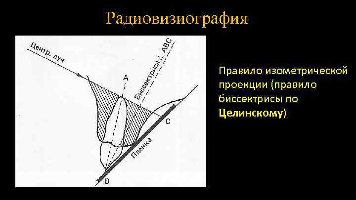 Радиовизиография Правило изометрической проекции (правило биссектрисы по Целинскому) 