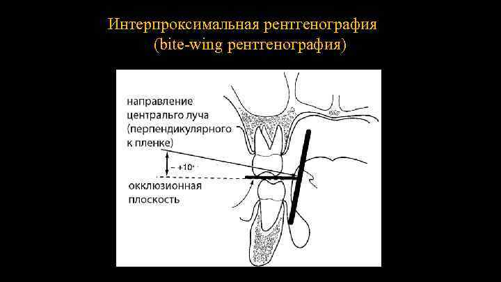 Интерпроксимальная рентгенография (bite-wing рентгенография) 