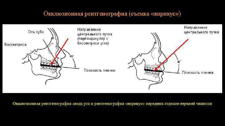 Окклюзионная рентгенография (съемка «вприкус» ) Окклюзионная рентгенография свода рта и рентгенография «вприкус» передних отделов