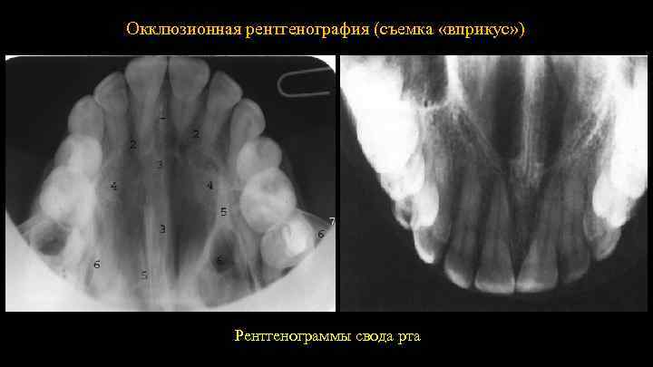 Окклюзионная рентгенография (съемка «вприкус» ) Рентгенограммы свода рта 