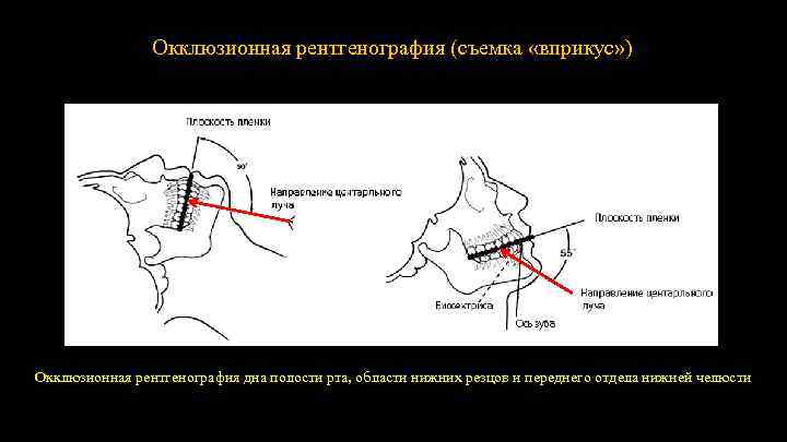 Окклюзионная рентгенография (съемка «вприкус» ) Окклюзионная рентгенография дна полости рта, области нижних резцов и
