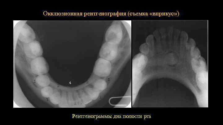 Окклюзионная рентгенография (съемка «вприкус» ) Рентгенограммы дна полости рта 