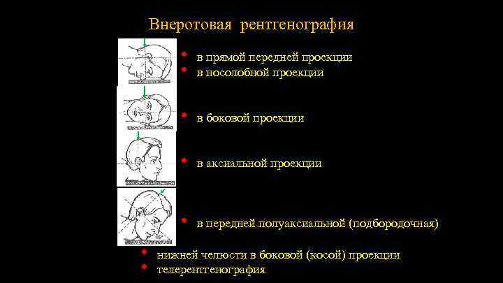 Внеротовая рентгенография • • • в боковой проекции • в аксиальной проекции • •