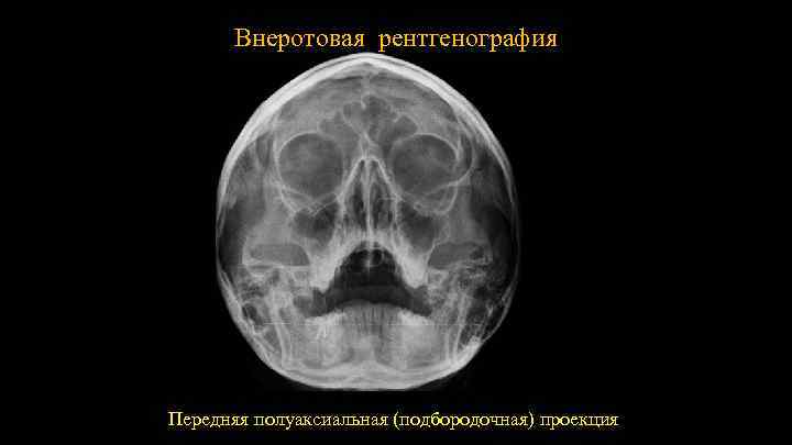Внеротовая рентгенография 14 3 Передняя полуаксиальная (подбородочная) проекция 