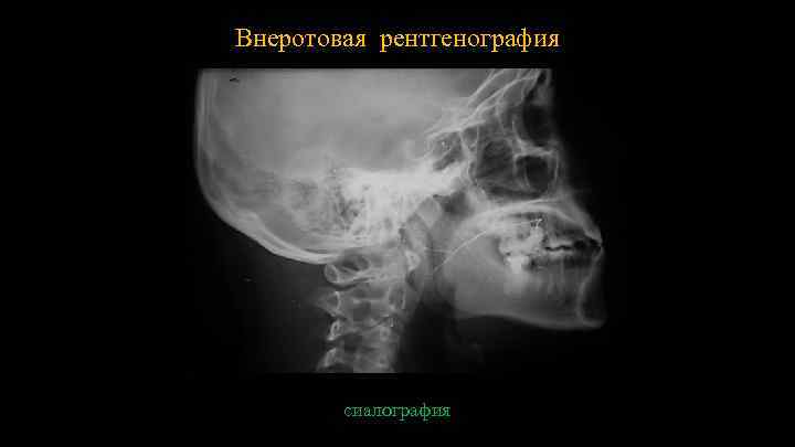 Внеротовая рентгенография сиалография 