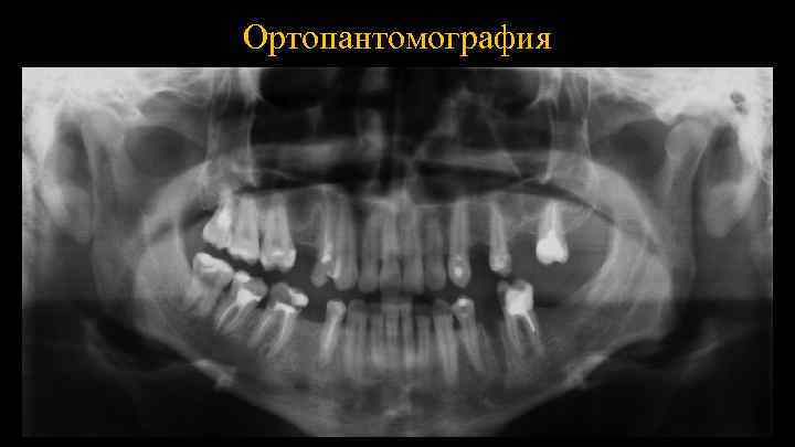 Ортопантомография 