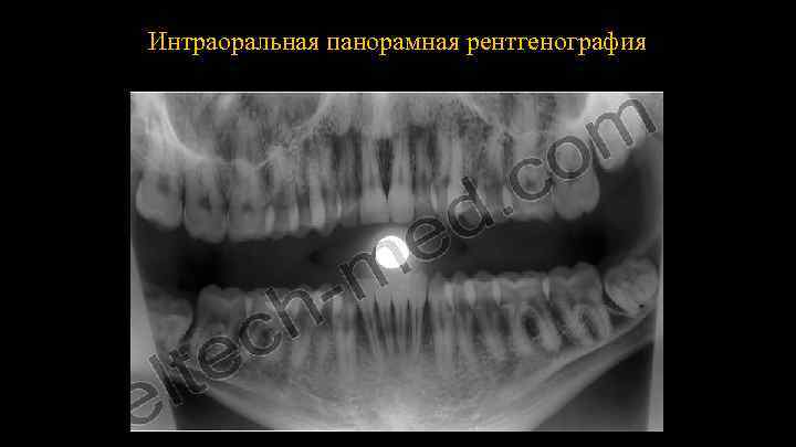 Интраоральная панорамная рентгенография 