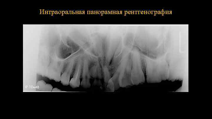 Интраоральная панорамная рентгенография 
