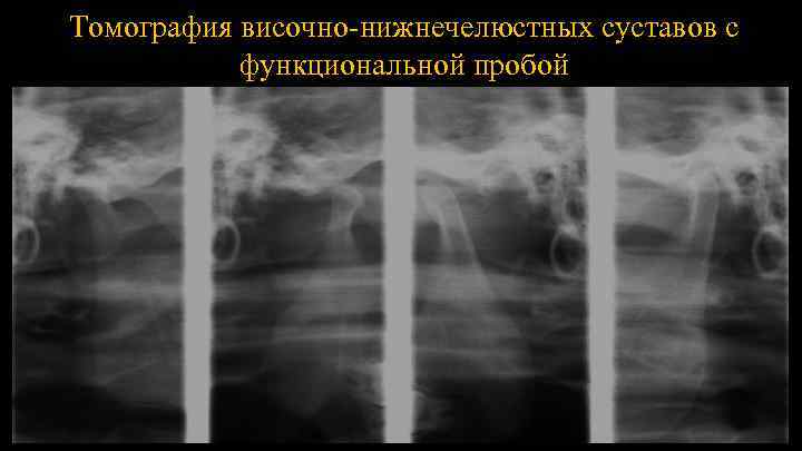 Томография височно-нижнечелюстных суставов с функциональной пробой 