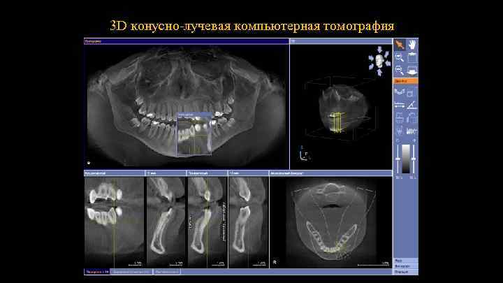 3 D конусно-лучевая компьютерная томография 