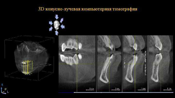 3 D конусно-лучевая компьютерная томография 