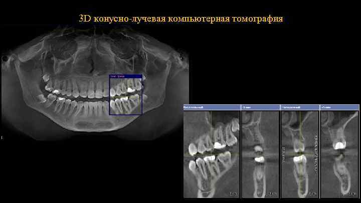3 D конусно-лучевая компьютерная томография 