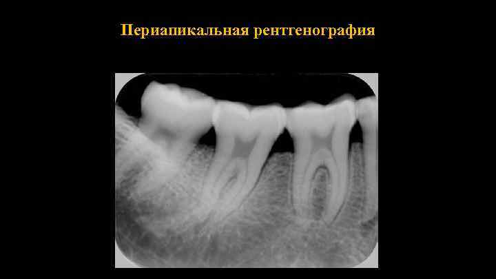 Периапикальная рентгенография 