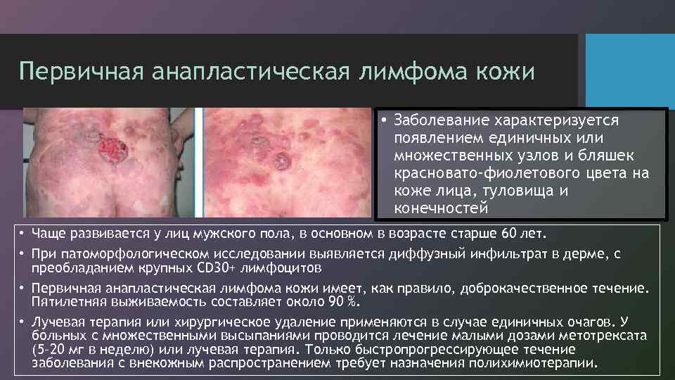 Первичная анапластическая лимфома кожи • Заболевание характеризуется появлением единичных или множественных узлов и бляшек