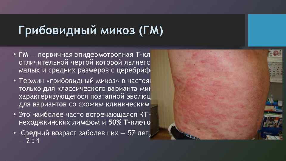 Грибовидный микоз (ГМ) • ГМ — первичная эпидермотропная Т-клеточная лимфома кожи, отличительной чертой которой